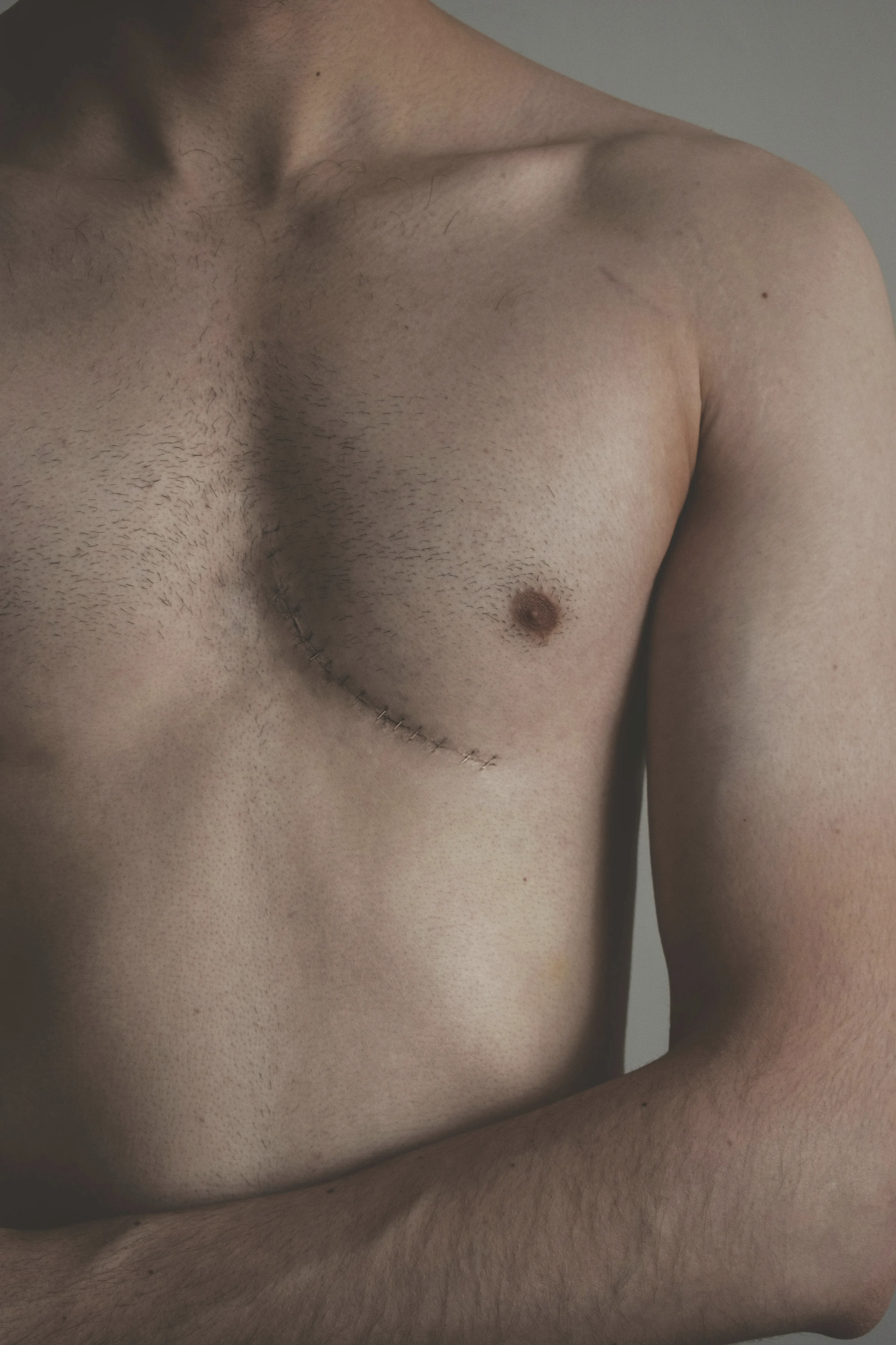 Gynecomastia Surgery